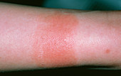 Contact dermatitis: wristwatch allergy