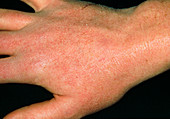 Dry skin reaction on hand due to anti-acne drug