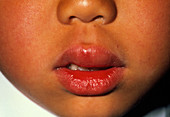 Swollen lip of boy due to peanut allergy