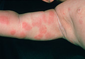 Rash on baby's arm due to food allergy