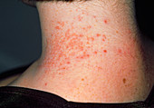 Contact dermatitis caused by necklace