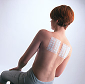 Young woman with allergy test patches on her back