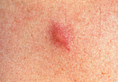 View of a mosquito bite on a patient's skin