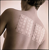 Young woman with allergy test patches on her back
