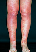 Allergic rash on legs