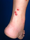 Ant stings on ankle