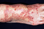 Rash from drug allergy