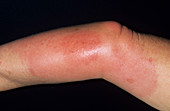 Wasp sting