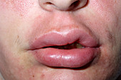 Swollen lip