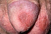 Drug-induced rash on penis