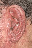 Drug-induced rash on ear