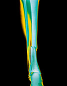 Coloured x-ray of fractured tibia