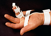 Splint on a broken finger