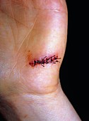 Stitches on a cut hand