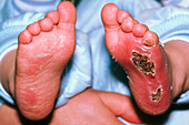 Non-accidental injury to a child's feet