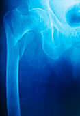 Fractured hip: X-ray of fractured femoral head