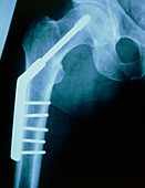 X-ray of a pinned human hip
