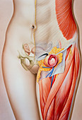 Illustration of a femoral hernia