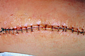 Metal staples closing a wound on a man's thigh