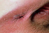 Fissure in anus resulting in an ulcer
