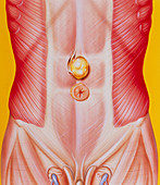 Illustration of an epigastric (abdominal) hernia