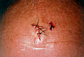 A sutured scalp laceration