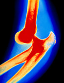 Coloured X-ray image showing a dislocated elbow