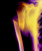 X-ray image of a fractured humerus