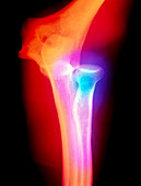 Coloured X-ray of a dislocated elbow joint