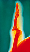 Col X-ray showing a dislocated phalanx in a finger