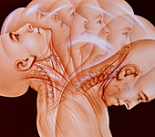 Illustration of a whiplash injury to the neck