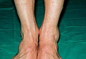 View of swollen left ankle due to sprain