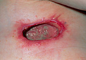 Wound infection in armpit after sympathectomy