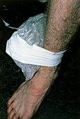 Rugby injury; ice-pack on bruised ankle