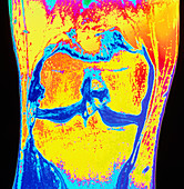 Coloured MRI of knee meniscus degeneration