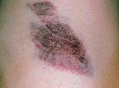 Bruising on patient's arm due to the drug Warfarin