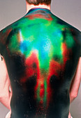 Liquid crystal thermography of a back injury