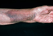 Bruising on a woman's arm due to fractured radius