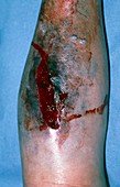 Laceration and haematoma on leg of elderly woman