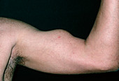 Torn head of biceps in 50-year-old man