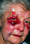 Blow-out fracture in elderly woman's eye orbit