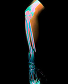 Coloured X-ray of fractured ulna/radius arm bones