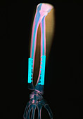 Coloured X-ray of arm fracture set with steel pins