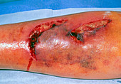 Infected lacerations on the leg of elderly woman
