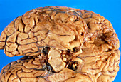 Human brain showing damage due to head injury
