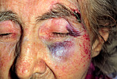 Bruised face & black eye of woman after fall