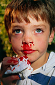 Boy,aged six,with nosebleed