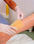 Hydrocolloid dressing being applied to leg