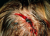 Head injury: laceration after fall by alcoholic