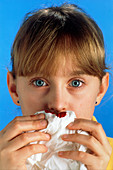 Young girl with a nosebleed